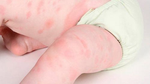 Trẻ 12 tháng nổi nhiều mẩn đỏ trên tay và chân có sao không, nên điều trị thế nào?