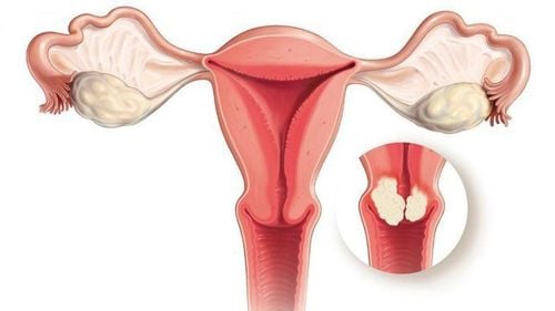 How to treat fibroids type 5 with ectopic in the uterus?