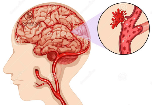 Mất khứu giác sau khi điều trị vỡ mạch máu não thùy trái có chữa khỏi được không?