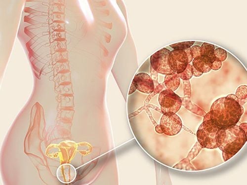 What to do with recurrent candidiasis?