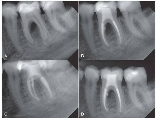 Thấu quang quanh chóp răng 46, có cone trong ống tủy có sao không?