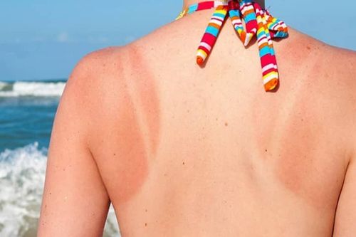 Caring for sunburned, dark skin