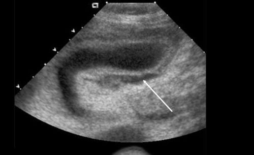 Is there any effect of subchondral fluid collection at 8 weeks pregnant?