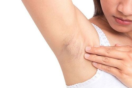 Dark, itchy armpits: Causes and treatment