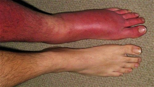 What is cellulitis?