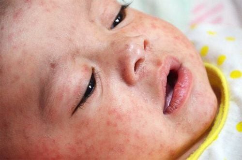 Trẻ sơ sinh bị bệnh sởi có triệu chứng như thế nào?