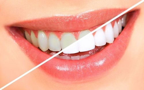 Advantages and disadvantages of current teeth whitening methods