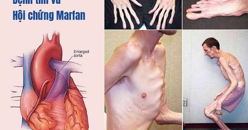 Heart damage due to Marfan's syndrome
