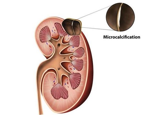 
Khi một đơn vị thận bị tắc thì sẽ hình thành nên túi chứa nước gọi là nang ở thận.
