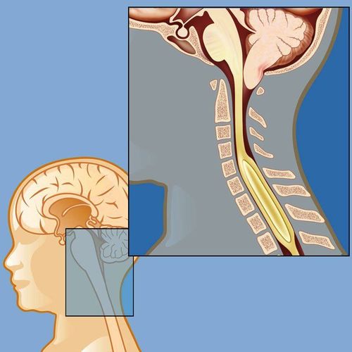 Hội chứng Arnold Chiari có nguy hiểm?