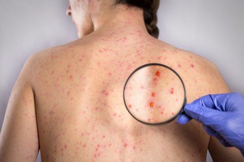 Khi nhiễm Rubella có thể điều trị như thế nào?