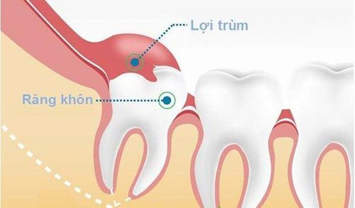 Trùm lợi khi mọc răng khôn phải làm sao?