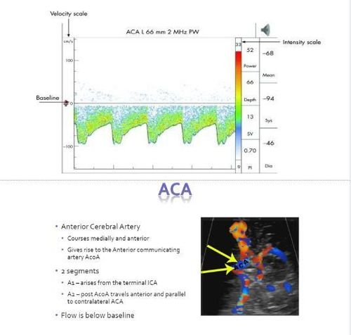 
Siêu âm doppler xuyên sọ động mạch não giữa, động mạch não trước
