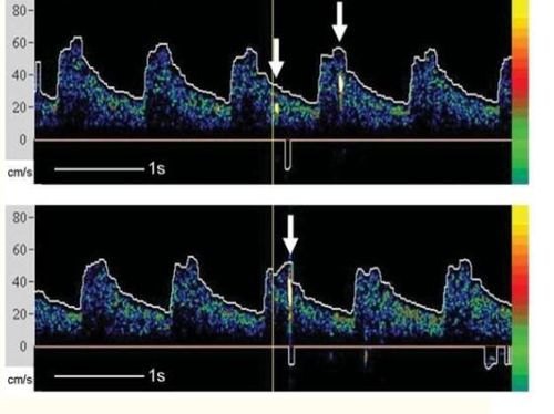 
Mũi tên chỉ ra các tín hiệu thoáng qua cường độ cao nhìn thấy với thuyên tắc trong siêu âm doppler xuyên sọ
