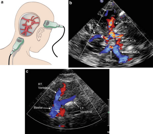 What is Transcranial Doppler Ultrasound? What are its clinical applications?