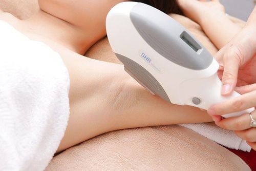 
Laser là một trong những phương pháp tẩy lông vĩnh viễn thường được sử dụng
