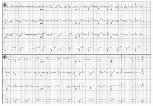 
Hình 1: Điện tim ở trường hợp 1. a) Điện tim biểu hiện một nhịp ngoại tâm thu nhĩ , ST chênh lên ở các chuyển đạo dưới. b) Điện tim làm lại cho thấy sóng Q ở điện cực dưới và ST không còn chênh lên.
