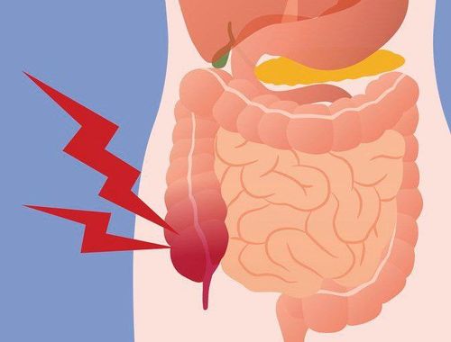 Is it okay to not have a drainage tube after appendectomy?