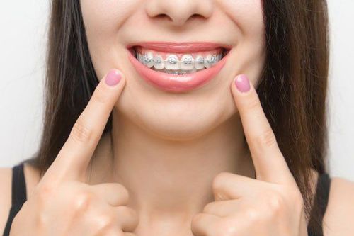 How much is the current price of braces and how is it calculated?