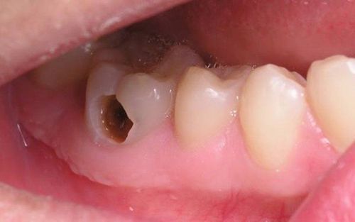 Treatment of teeth with holes in them due to decay