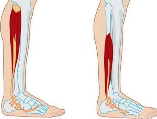 Chẩn đoán teo cơ như thế nào?