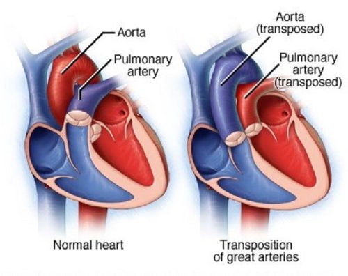 What is arteriosclerosis?