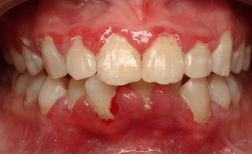 Is gingival curettage surgery painful?