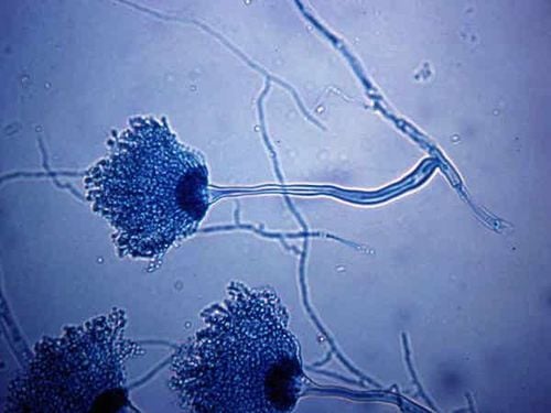 
Bệnh phổi do nấm Aspergillus là một viêm phổi nặng
