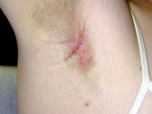 Plucking armpit hair with lymph nodes, is it dangerous?