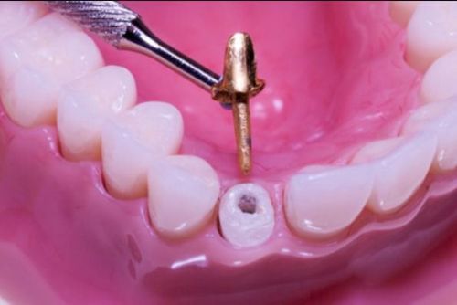 Restoration of crowns with latches