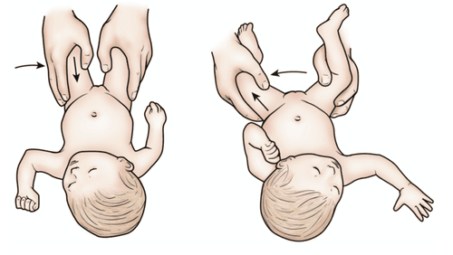 Loạn sản phát triển của khớp háng (DDH)