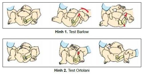 
Dấu hiệu trật khớp háng bẩm sinh có thể phát hiện khi sử dụng nghiệm pháp Ortolani và Barlow.
