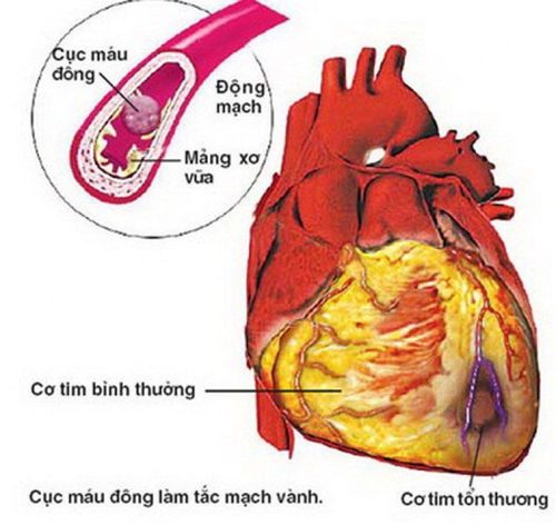 Diagnostic criteria for myocardial ischemia