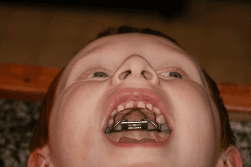 Note when dilating the jaw for children