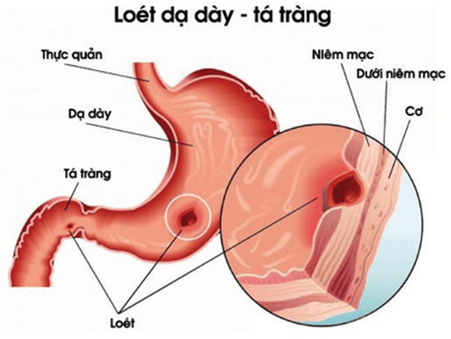 Điều trị viêm loét dạ dày tá tràng có biểu hiện buồn nôn, đi ngoài phải làm sao?