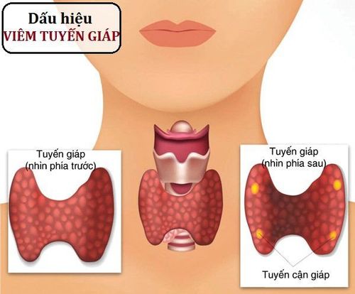 
Viêm tuyến giáp là một trong những nguyên nhân gây suy giáp ở trẻ
