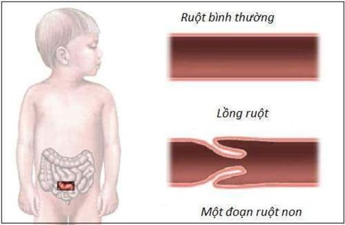 
Lồng ruột cấp ở trẻ bú mẹ rất thường gặp và là nguyên nhân gây tắc ruột
