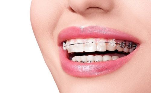 How long is the minimum time for braces?