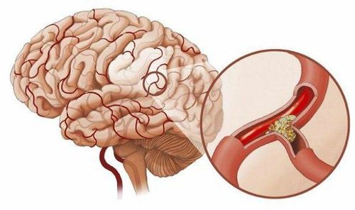 Chảy máu trong não nguy hiểm thế nào?