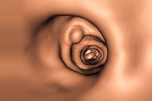 What is a sessile colon polyp?