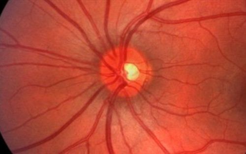 Mắt bị viêm tủy thị thần kinh có phục hồi được không?