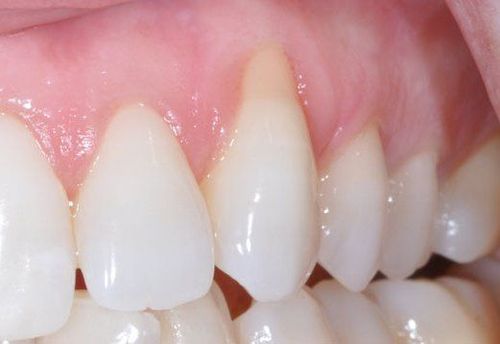 Fix worn tooth root