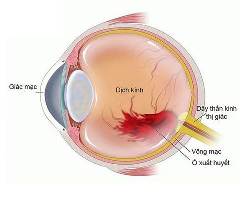 
Hình võng mạc dịch kính bị xuất huyết
