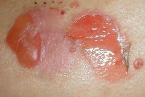 Taking care of people with Pemphigus with skin lesions