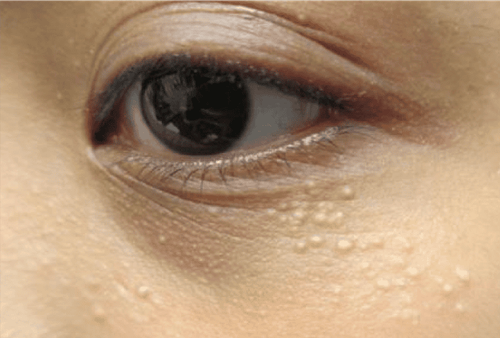 Sweat duct tumors: Diagnosis and treatment