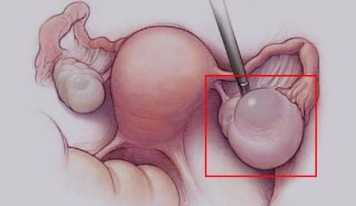 U nang nước buồng trứng là bệnh lý u nang buồng trứng thường gặp