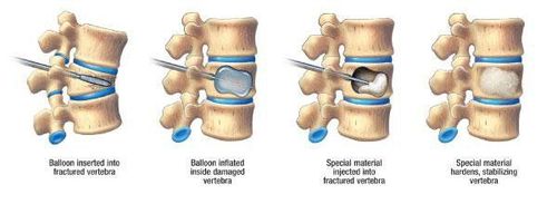 Chụp MRI để thực hiện bơm xi măng sinh học và truyền loãng xương được không?