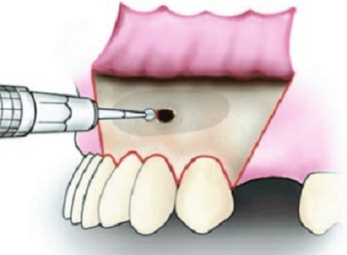 
Chóp răng bị viêm nhiễm cần được loại bỏ
