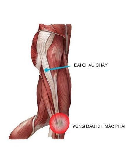 Iliotibial band syndrome (ITBS)