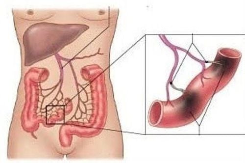 Vai trò của phẫu thuật trong chẩn đoán và điều trị tắc mạch mạc treo